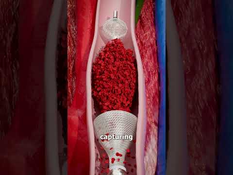 Removing Blood Clots with Vacuum 😨